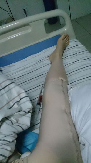 【大腿環(huán)吸+肉毒素瘦小腿】實現(xiàn)長腿美女不是夢 - 珍美網(wǎng)