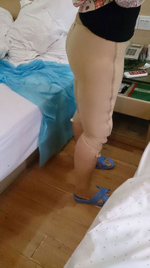 【大腿環(huán)吸+肉毒素瘦小腿】實現(xiàn)長腿美女不是夢 - 珍美網(wǎng)