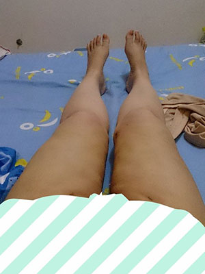 【大腿環(huán)吸+肉毒素瘦小腿】實現(xiàn)長腿美女不是夢