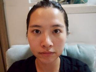 面部自體脂肪填充 還原最美的自己 - 珍美網(wǎng)
