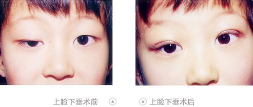 上臉下垂矯正價格是多少錢