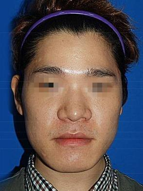 面部整形 屌絲男變男神帥帥噠 - 珍美網(wǎng)