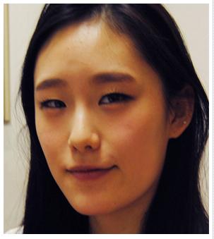 眼部整形 無神小眼變有神大眼美眉 - 珍美網(wǎng)