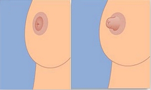 乳頭內(nèi)陷矯正需要多少錢(qián)