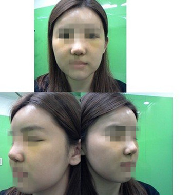 隆鼻整形 蹋鼻女王變高挺鼻女王 - 珍美網(wǎng)