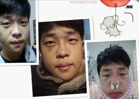 雙額整形+鼻子修復(fù) 更加帥氣又魅力 - 珍美網(wǎng)