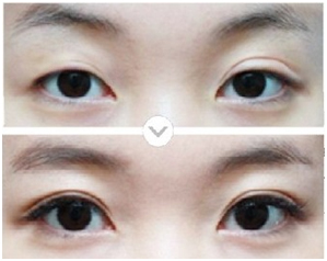 雙眼皮失敗修復(fù)費(fèi)用是多少