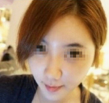 面部整形 讓面部飽滿變童顏美女