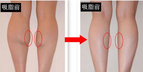 小腿吸脂費用是多少