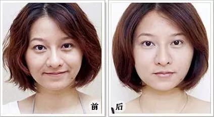 熱瑪吉除皺有什么優(yōu)勢