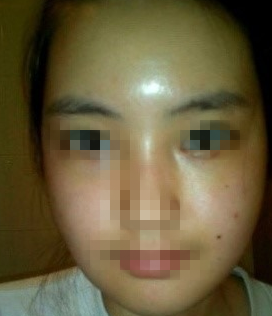 玻尿酸豐額頭 變側(cè)顏美女 - 珍美網(wǎng)