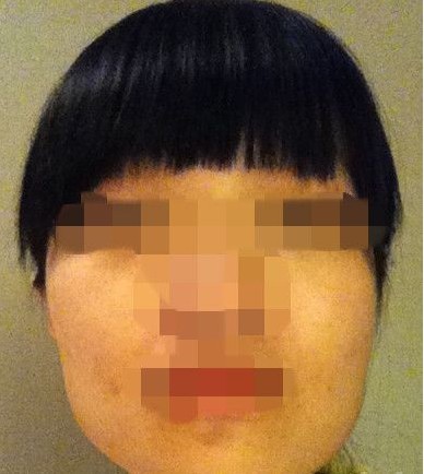 下頜角手術(shù) 實現(xiàn)甜美清新小臉 - 珍美網(wǎng)
