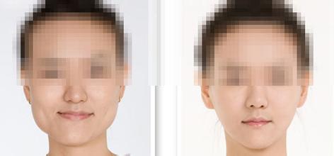 下頜角整形的后遺癥有哪些