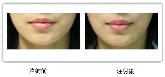 伊維蘭豐唇手術(shù)價格是多少