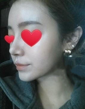 假體隆鼻 讓自己更加自信美麗