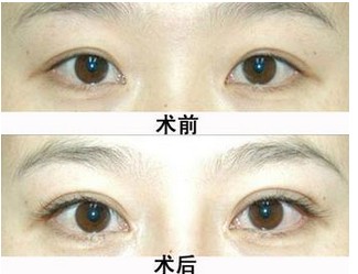 睫毛種植的價格是多少