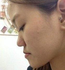 地包天矯正術(shù) 實現(xiàn)活潑美麗的自己 - 珍美網(wǎng)