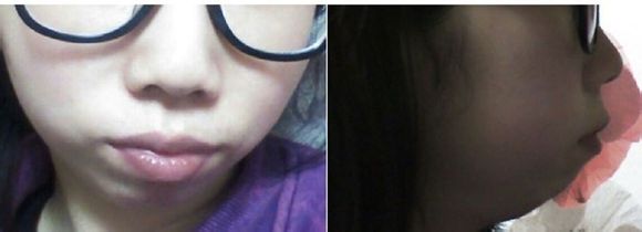假體墊下巴 讓自己的側(cè)顏?zhàn)兊酶用滥?- 珍美網(wǎng)