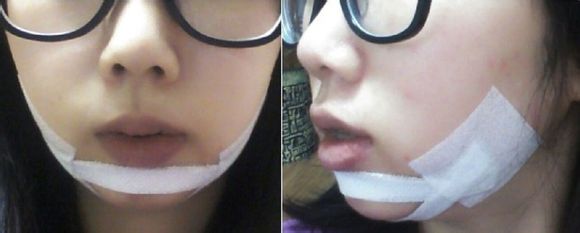 假體墊下巴 讓自己的側(cè)顏?zhàn)兊酶用滥?- 珍美網(wǎng)