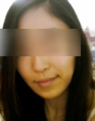 面部脂肪移植 讓自己變得更加自信美麗 - 珍美網(wǎng)