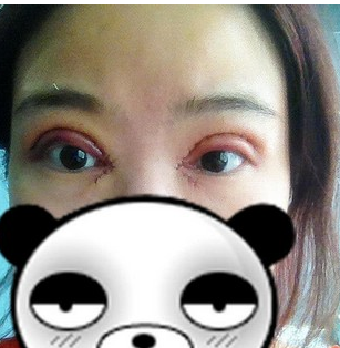 全切雙壓迫+開(kāi)眼角 擁有明亮又美麗的大眼美眉 - 珍美網(wǎng)