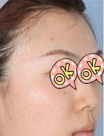隆鼻手術(shù) 實(shí)現(xiàn)更美的自己 - 珍美網(wǎng)