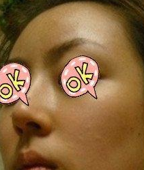 隆鼻手術(shù) 實(shí)現(xiàn)更美的自己 - 珍美網(wǎng)