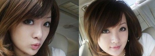 Vline+面部填充 飽滿起來更加年輕美麗 - 珍美網(wǎng)