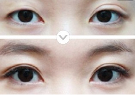 雙眼皮失敗修復(fù)術(shù)的效果怎么樣