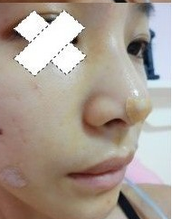 隆鼻整形 做勇敢美麗的自己 - 珍美網(wǎng)