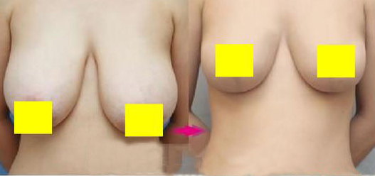 巨乳縮小手術(shù)的危害有哪些
