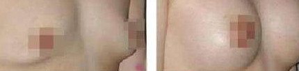 乳房再造術(shù)效果怎么樣