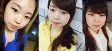 割雙眼皮+墊鼻子 越來越愛自己啦 - 珍美網(wǎng)