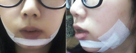 假體墊下巴 有下巴的感覺就是美的不要不要 - 珍美網(wǎng)