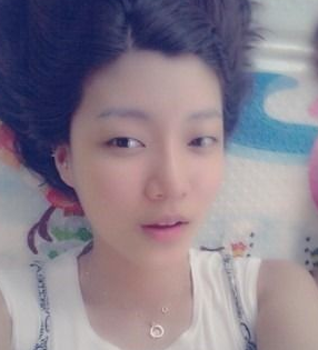 自體脂肪豐額頭 讓面部整體看起來更加氣質(zhì)美麗 - 珍美網(wǎng)
