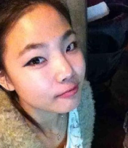 雙眼皮手術 原來變美麗這么簡單啊 - 珍美網