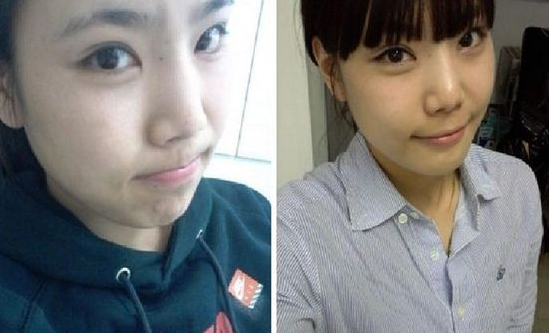 雙眼皮手術 原來變美麗這么簡單啊 - 珍美網