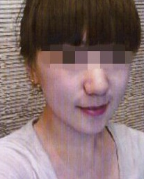 瘦臉吸脂 驚艷了自己的眼睛怎么這么美 - 珍美網(wǎng)