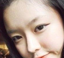 面部整形 變甜美清新小美女 - 珍美網