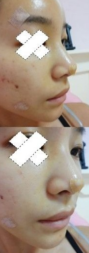 隆鼻手術(shù) 更成熟更有魅力了 - 珍美網(wǎng)