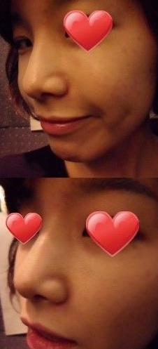 隆鼻手術(shù) 更成熟更有魅力了