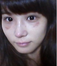 隆鼻手術(shù) 讓我更加充滿(mǎn)信心 - 珍美網(wǎng)