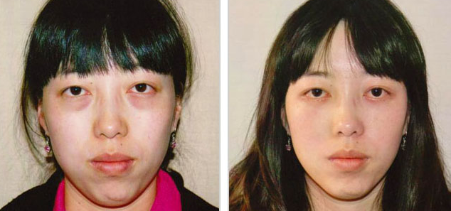 激光去眼袋有哪些副作用