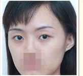注射玻尿酸 熊貓眼也可以消的干凈 - 珍美網(wǎng)