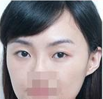 注射玻尿酸 熊貓眼也可以消的干凈