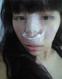 駝峰鼻整形 整體面部都很精致了 - 珍美網(wǎng)