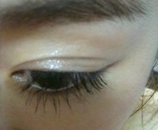 雙眼皮手術(shù) 魅力大眼睛值得擁有 - 珍美網(wǎng)