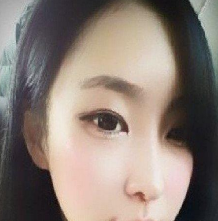 面部整形 終于擁有了自己想要的雞蛋型臉