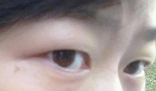 雙眼皮手術(shù) 發(fā)現(xiàn)雙眼皮的魅力好大 - 珍美網(wǎng)