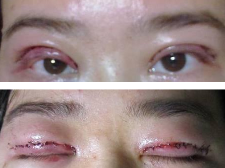雙眼皮手術(shù) 發(fā)現(xiàn)雙眼皮的魅力好大 - 珍美網(wǎng)